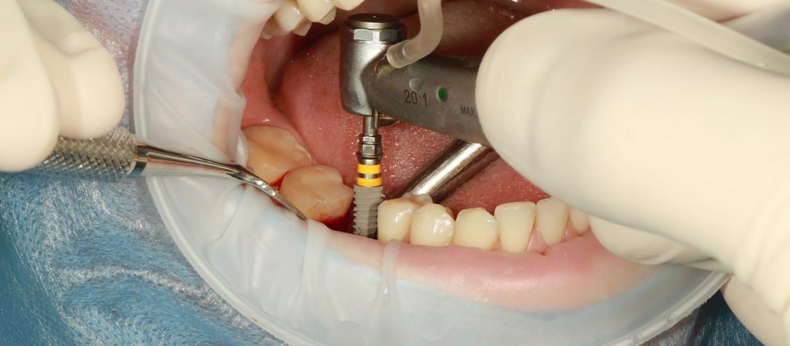 dental implant