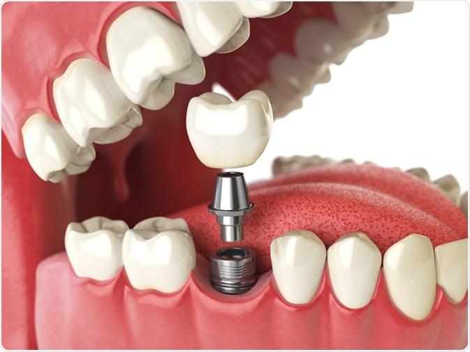 Current‍ Trends in Dental​ Implant Technology