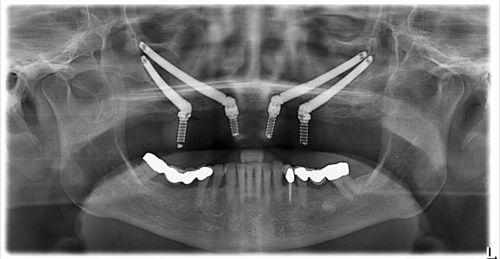 Long-Term Success: Factors Influencing the Durability of Zygomatic ​Implants