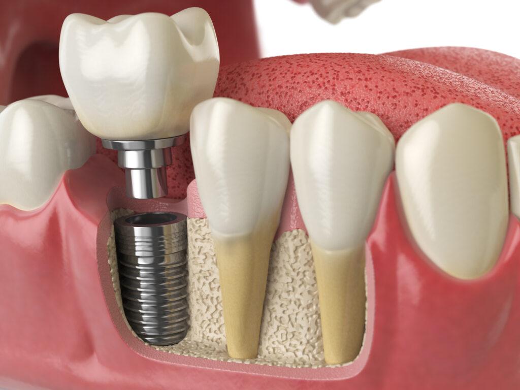 Understanding the Fundamentals of Dental implant Longevity