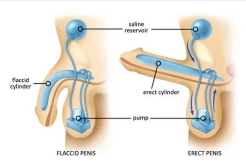 What Is ED Velsipity UC Treatment? Everything You Need to Know