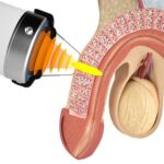 Clinical Review: ED Velsipity UC Treatment Results in 2024