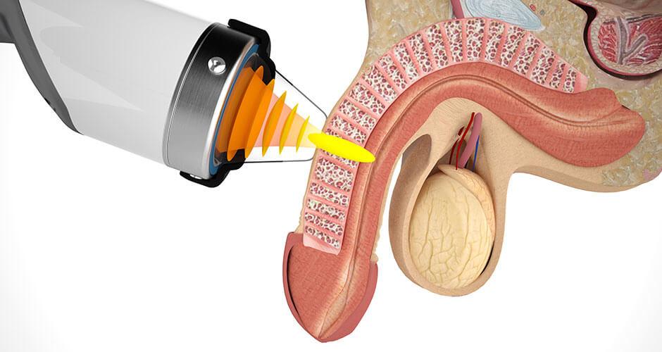 Clinical Review: ED Velsipity UC Treatment Results in 2024