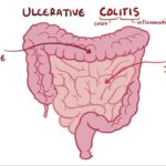 Real Patient Reviews of Velsipity for Ulcerative Colitis and ED