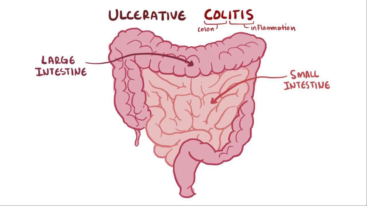 Real Patient Reviews of Velsipity for Ulcerative Colitis and ED