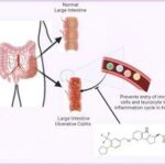 ED Velsipity UC Treatment: Doctor Opinions and Patient Advice