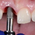 What to Expect Before, During, and After Implant Surgery