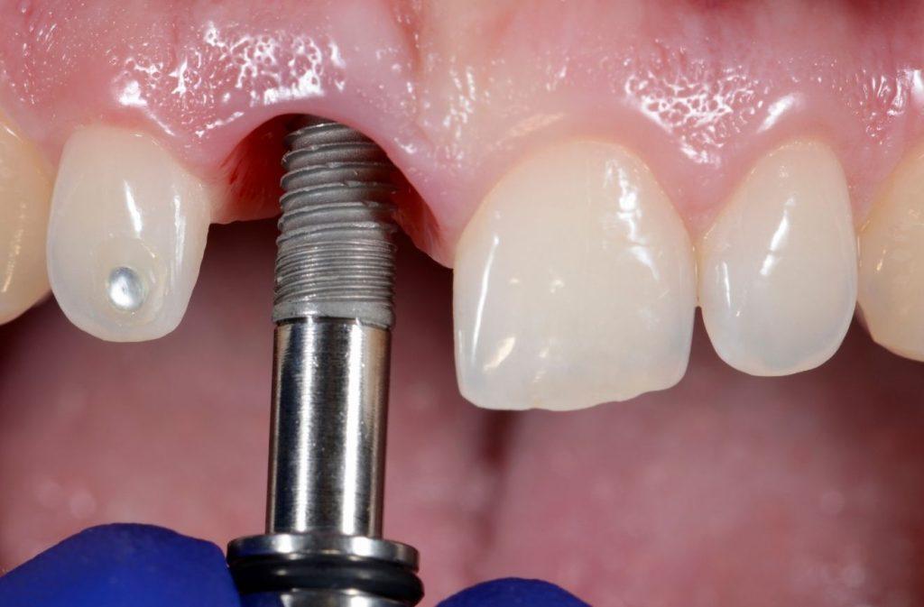 What to Expect Before, During, and After Implant Surgery