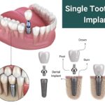 Top 10 Dental Implant Brands Dentists Recommend in 2024