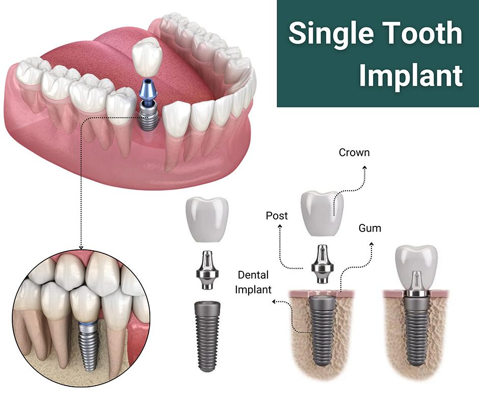 Top 10 Dental Implant Brands Dentists Recommend in 2024