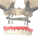 Endosteal vs. Subperiosteal Implants: What’s the Difference?