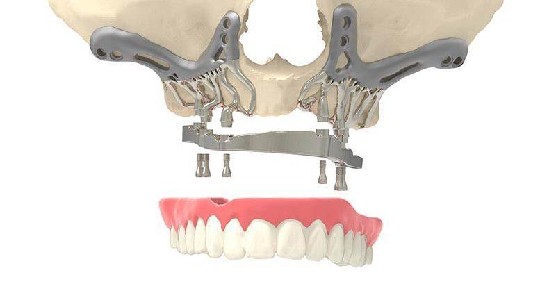 Endosteal vs. Subperiosteal Implants: What’s the Difference?