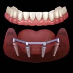 Types of Dental Implants: Which One Is Right for You?