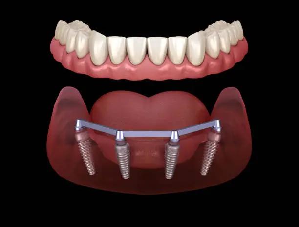 Types of Dental Implants: Which One Is Right for You?