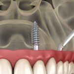 Zygomatic Dental Implants: A Solution for Severe Bone Loss
