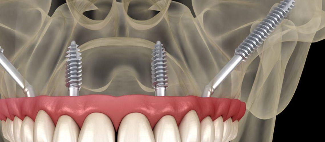Zygomatic Dental Implants: A Solution for Severe Bone Loss