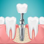 Foods to Avoid After Dental Implant Surgery