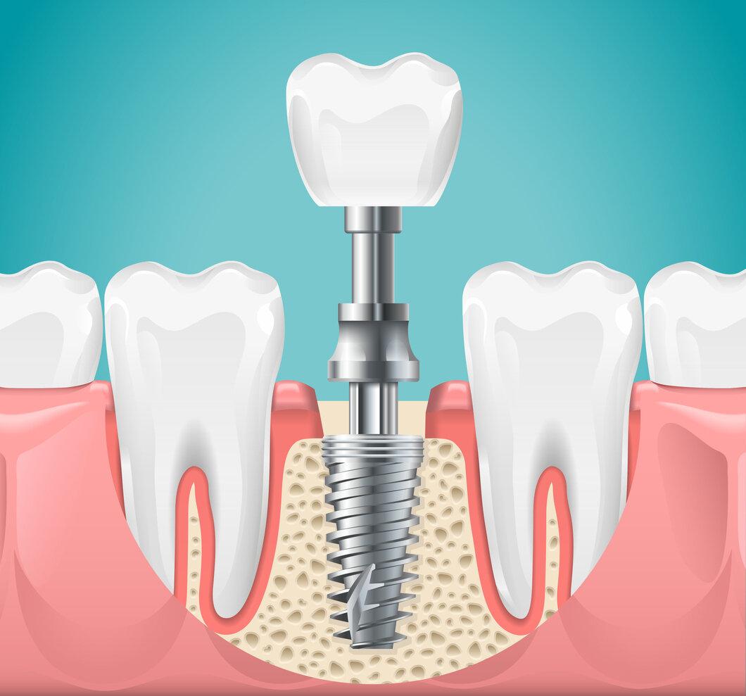 Foods to Avoid After Dental Implant Surgery