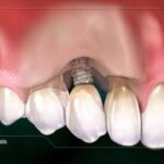 Signs Your Dental Implant May Be Failing — and What to Do