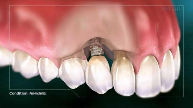 Signs Your Dental Implant May Be Failing — and What to Do
