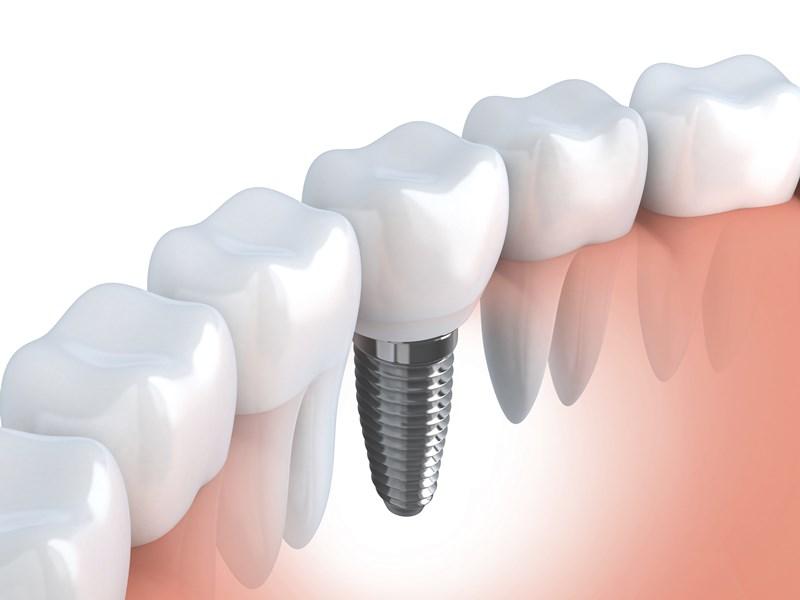 Evaluating Long-Term Success Rates of ‍American and Korean Implants
