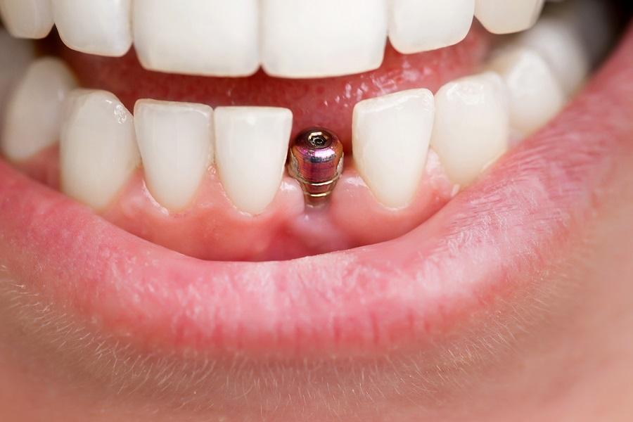 Long-Term Success: ⁤Follow-Up ⁤and ⁢Maintenance for Your Implant