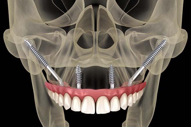 Post-Operative Care and Recovery‌ Tips‌ for Optimal Results