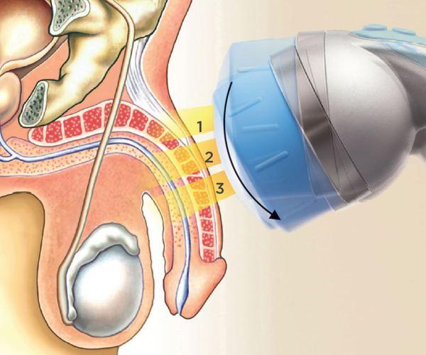 Side Effects‍ and Safety Concerns: Weighing the Risks of Each Approach