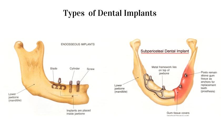 Longevity⁤ and ‍Success​ Rates: Which Implant ⁣stands the test of Time