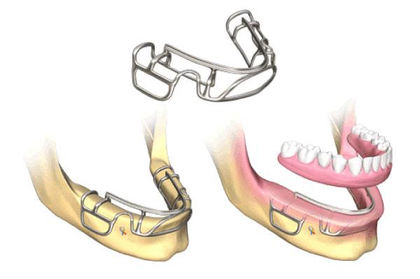 Subperiosteal Implants: A solution for Challenging Anatomy
