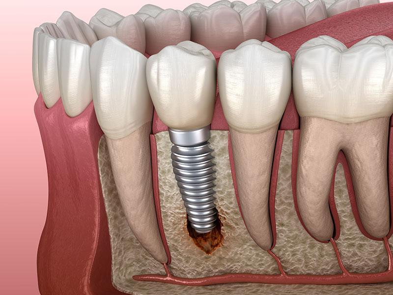 Recognizing the red Flags of Dental Implant Failure