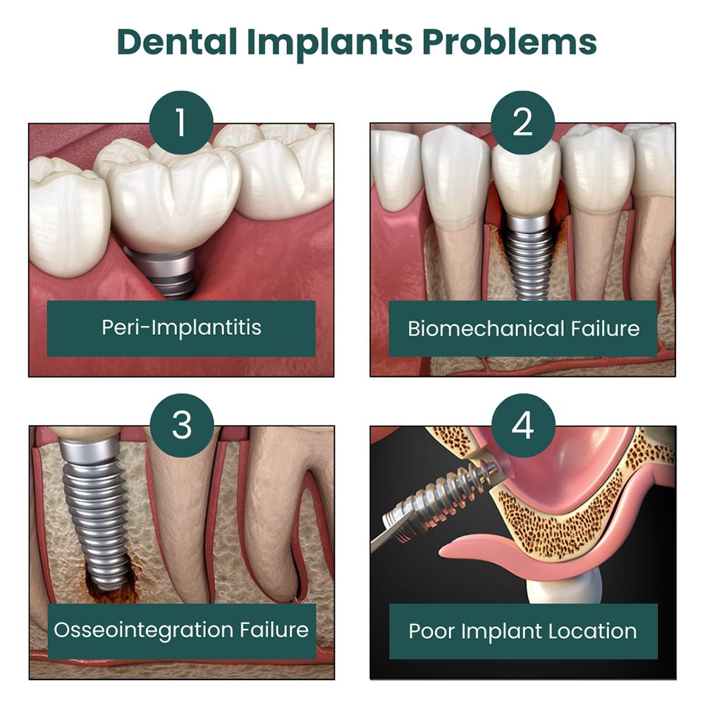 Exploring Treatment Options‌ for a Failing Implant