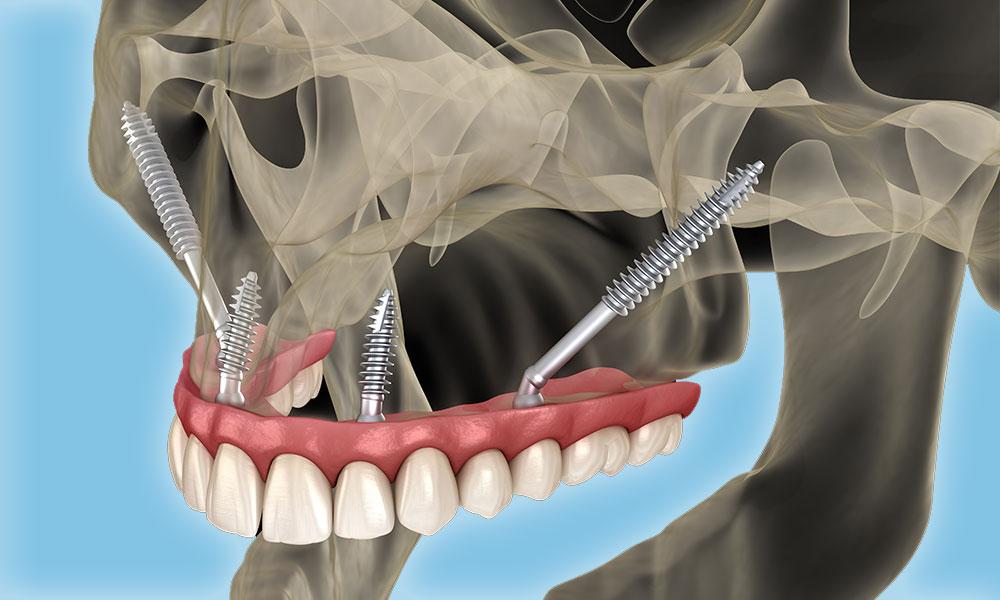 understanding ⁣Zygomatic Dental Implants ⁤and⁢ Their Unique Benefits