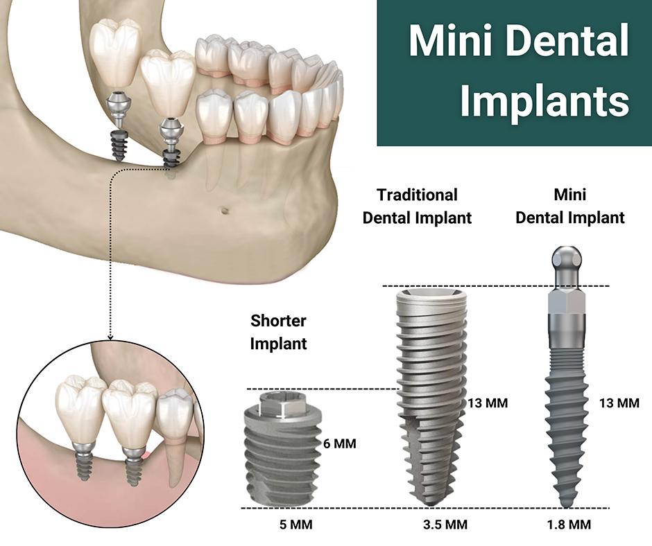 Ideal Candidates for ⁢Mini Dental Implants: Assessing When They're the Right Choice for you