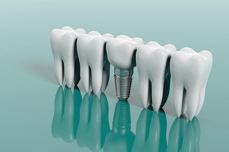 Understanding Endosteal Implants and Their ​Advantages