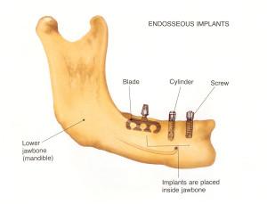 Comparative Analysis of Surgical ‌Procedures: Endosteal vs.Subperiosteal
