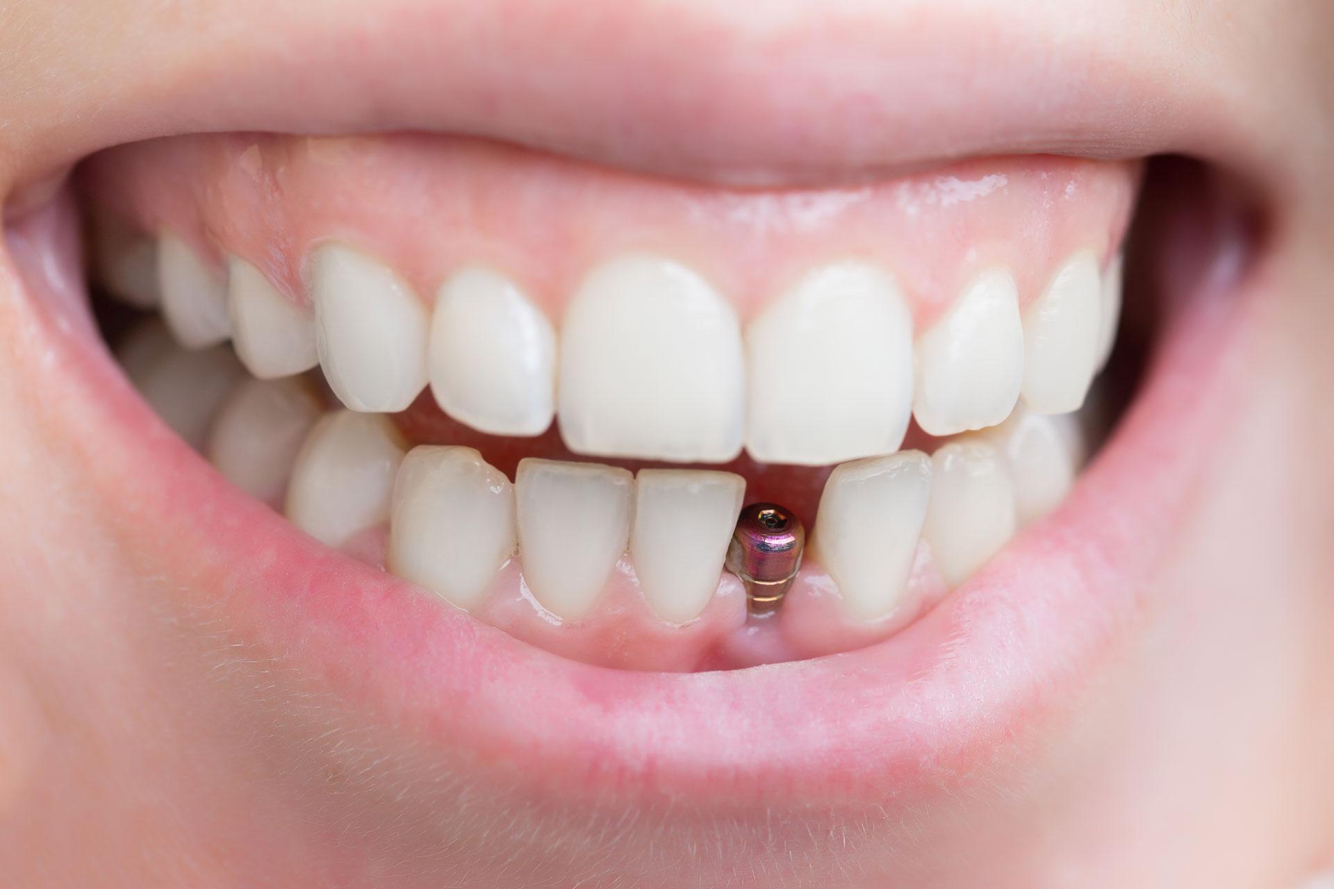 Endosteal Implants: The‍ Standard of Care⁢ in ‍Modern Dentistry