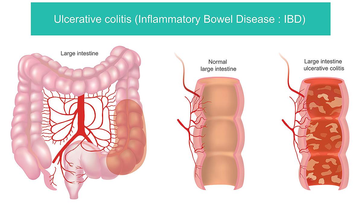 Understanding⁤ Ulcerative Colitis and the Role of Velsipity in‍ Treatment