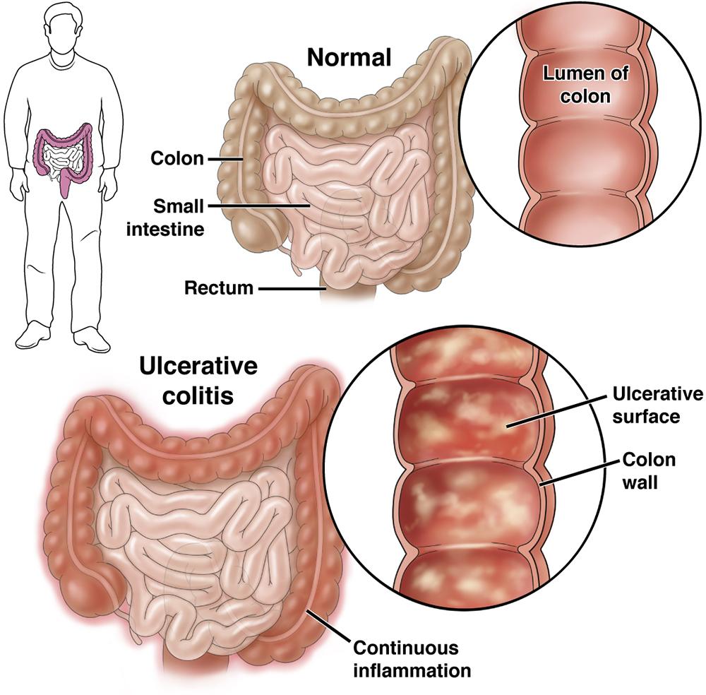 ED Velsipity UC Treatment (How): Step-by-Step Patient Guide