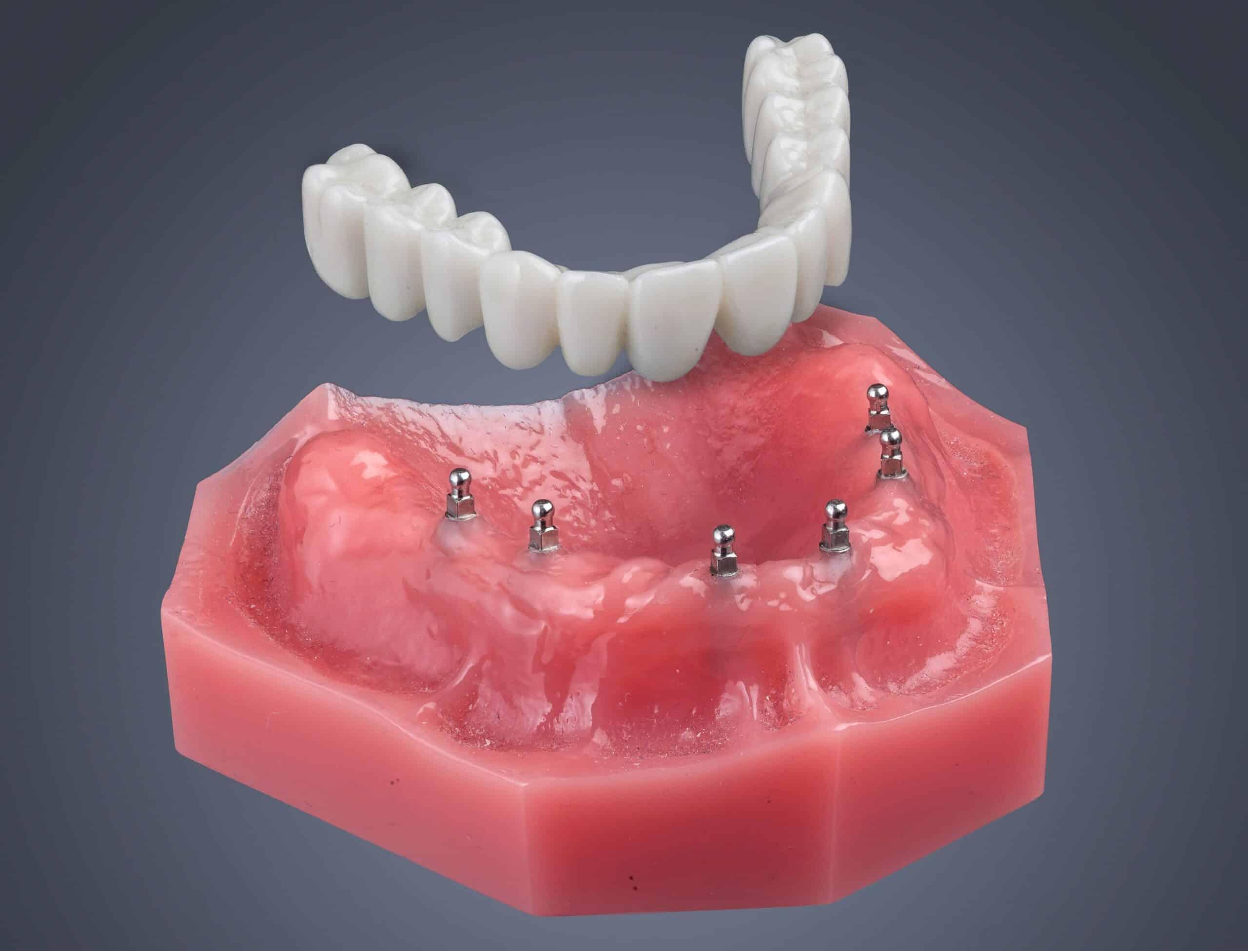 Understanding Mini Dental Implants: An Overview of Their Unique Design⁢ and Functionality